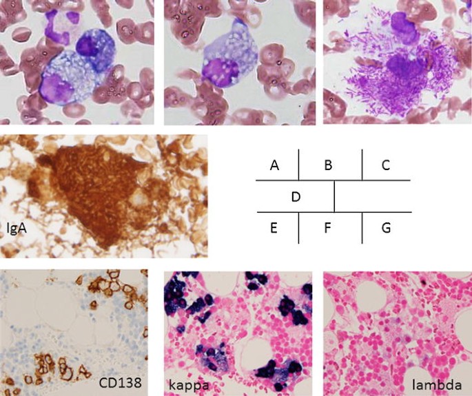 Multiple Myeloma With Russell Bodies And Needle Shaped Crystalline Inclusions Springerlink