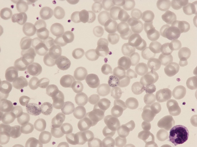 Lead Poisoning As Final Diagnosis In A Study Of Normocytic Anemia Springerlink