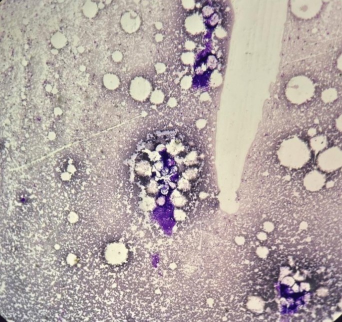 "A tale of the uncommon: a case series on extramedullary plasmacytoma ...