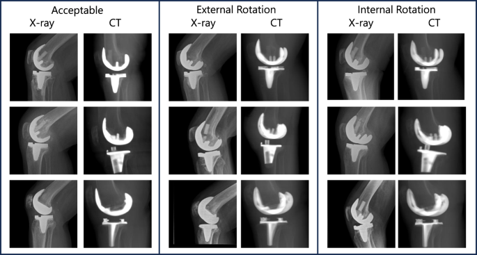 Deep learning-based support system for alignment classification and ...