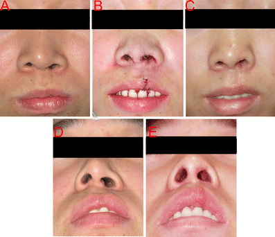 New Technique for Correction of the Microform Cleft Lip Using  Trans/Intraoral Approach | Indian Journal of Surgery