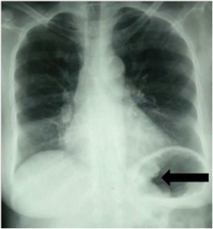 abdominal x ray cancer)