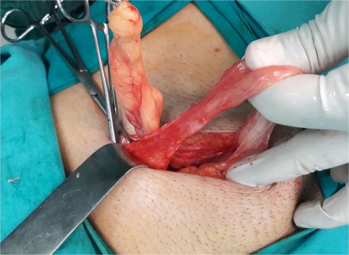 Missed Inguinal Cord Lipoma May Mimic Recurrence Following Endoscopic  Repair of Groin Hernias | SpringerLink