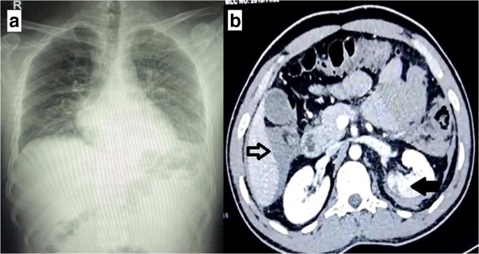 Delayed Presentation of Colonic Injury Following Blunt Abdominal Trauma | SpringerLink Delayed Presentation of Colonic Injury Following Blunt Abdominal Trauma | SpringerLink