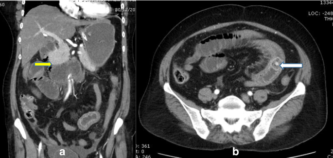 Cholecystoduodenal Fistula Causing Gallstone Ileus Springerlink