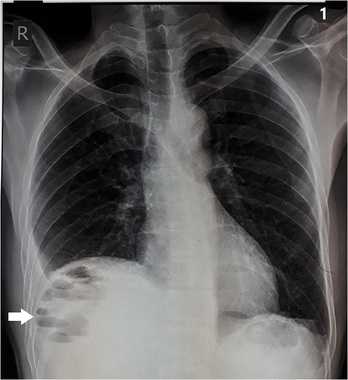 Multiple AirFluid Levels Under Right Dome of the Diaphragm Indian Journal of Surgery