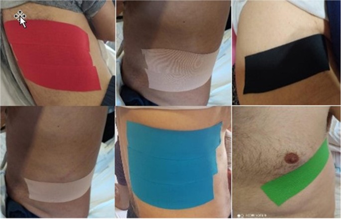 The Comparison of Analgesics and Kinesiological Taping in Rib Fractures |  SpringerLink