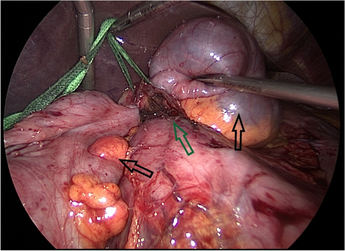 Simultaneous Winslow and Petersen&rsquo;s Hernias after a Roux-en-Y 