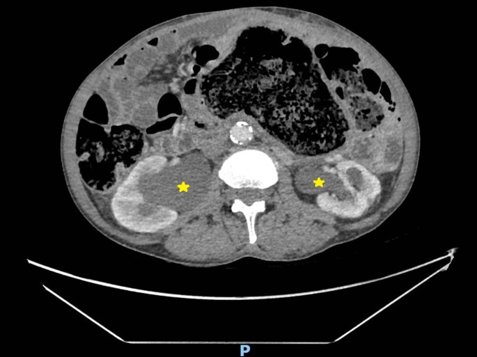 Giant Fecaloma Induced Bilateral Hydronephrosis: Renal Recovery ...
