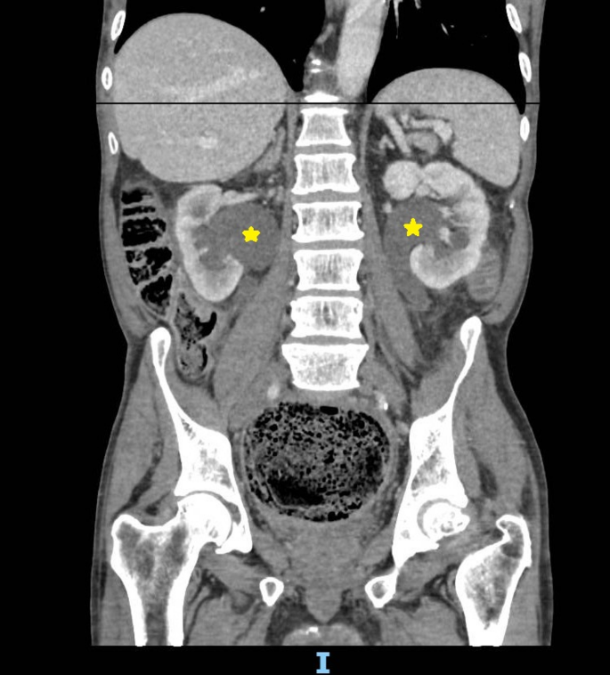 Giant Fecaloma Induced Bilateral Hydronephrosis: Renal Recovery ...
