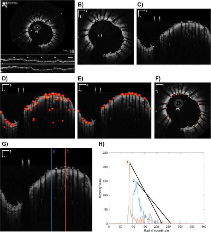 Patient-Specific Modeling of Stented Coronary Arteries ...