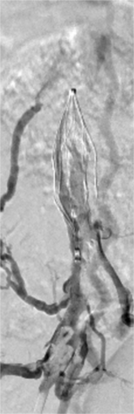 使用血管内血栓切除术的血管辅助血栓栓塞的猪模型 Journal Of Cardiovascular Translational Research X Mol 使用血管内血栓切除术的血管辅助血栓栓塞的猪模型 Journal Of Cardiovascular Translational Research X Mol
