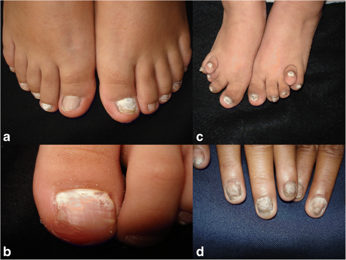 Onychomycosis In Children With Down Syndrome Springerlink
