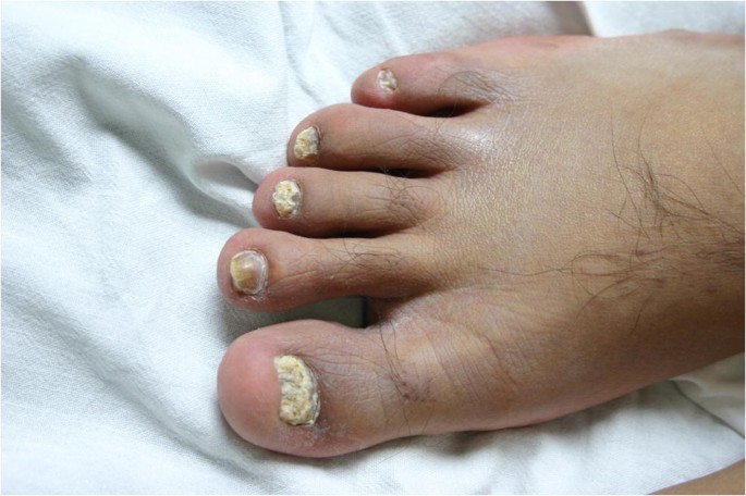 Onychomycosis in Patients Living with HIV/AIDS | Current Fungal Infection  Reports