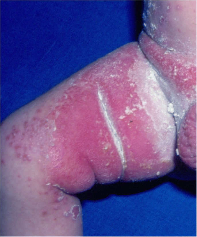 Skin Fungal Infections in Children: Diagnostic Challenges | SpringerLink