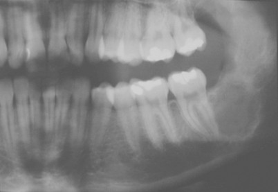 Odontogene Tumoren Springerlink
