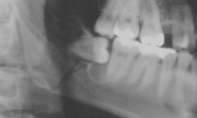 Odontogene Tumoren Springerlink