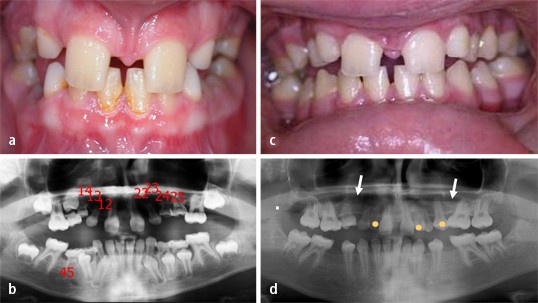 Interimsprothese frontzahn erfahrungen