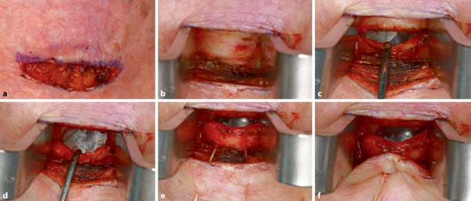 Tracheotomie | Die MKG-Chirurgie | Springer Nature Link