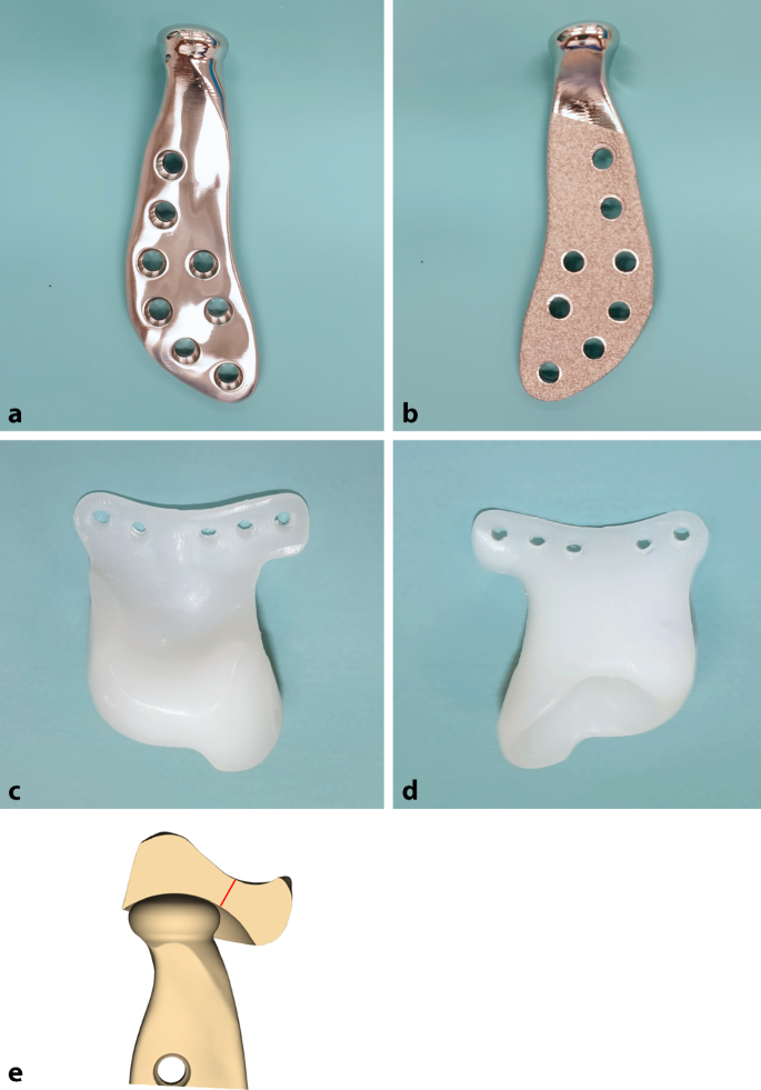 Der alloplastische Kiefergelenkersatz in der klinischen Anwendung | Die  MKG-Chirurgie | Springer Nature Link