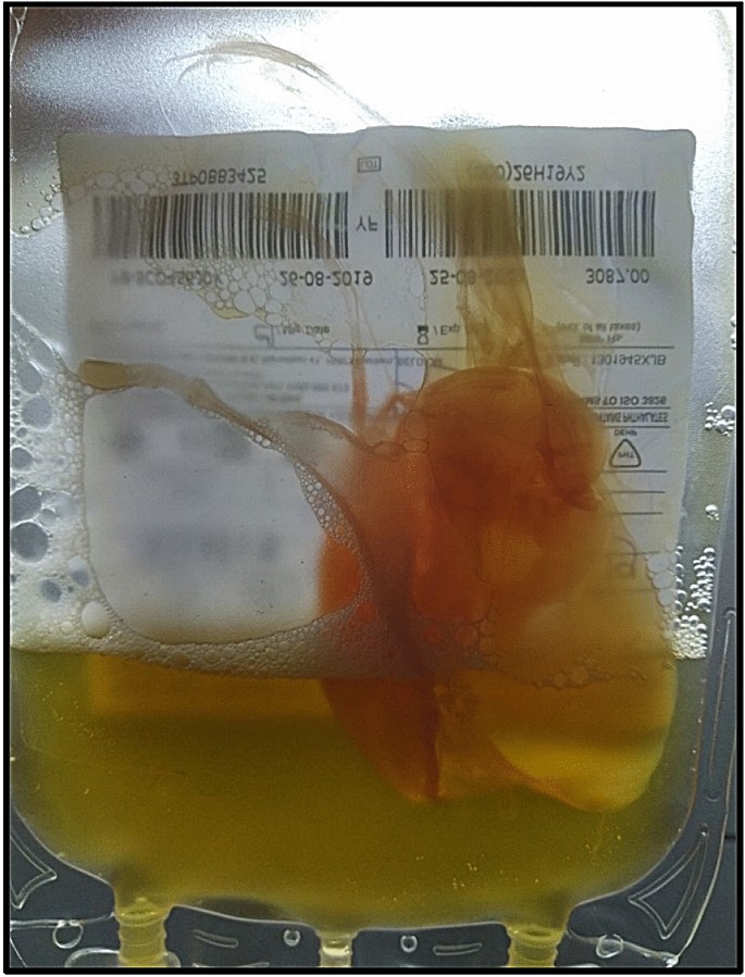 Large Fibrinous Coagulum in the Platelet Bag: A Hint Towards Bacterial  Contamination | SpringerLink