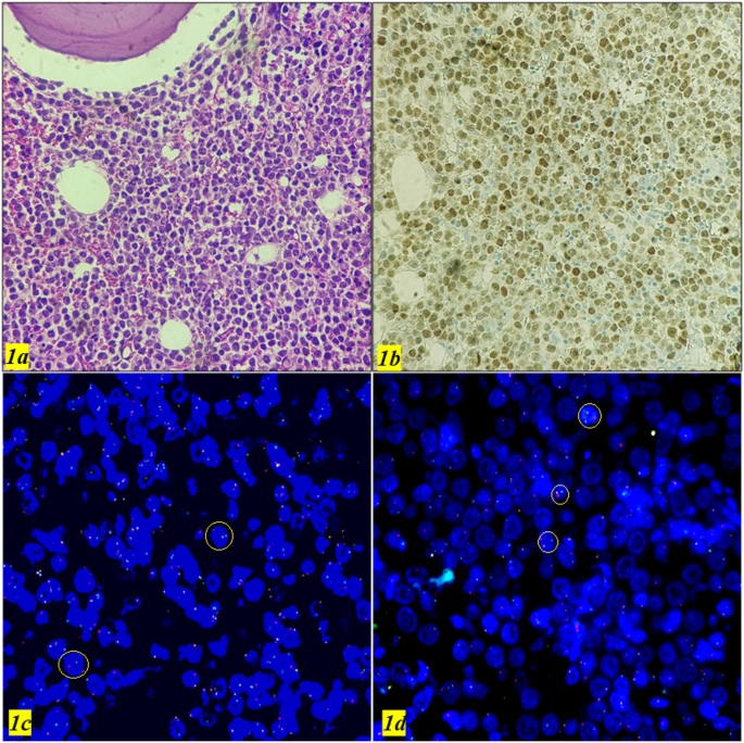 High Grade B-cell Lymphoma with MYC and BCL-2 Rearrangements with a ...