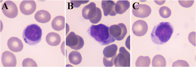 Auer Rod–Like Inclusions in T-cell Large Granular Lymphocytic Leukaemia ...