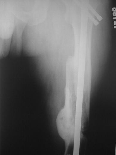 A comparison of intramedullary nailing and plate-screw fixation in the treatment for ipsilateral fracture of the hip and femoral shaft | SpringerLink A comparison of intramedullary nailing and plate-screw fixation in the treatment for ipsilateral fracture of the hip and femoral shaft | SpringerLink