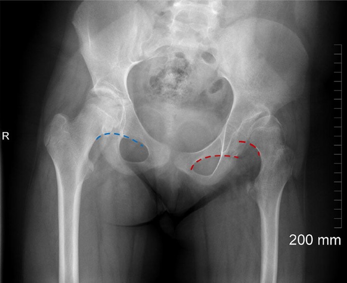 Assessment Of The Young Adult Hip Joint Using Plain Radiographs Springerlink