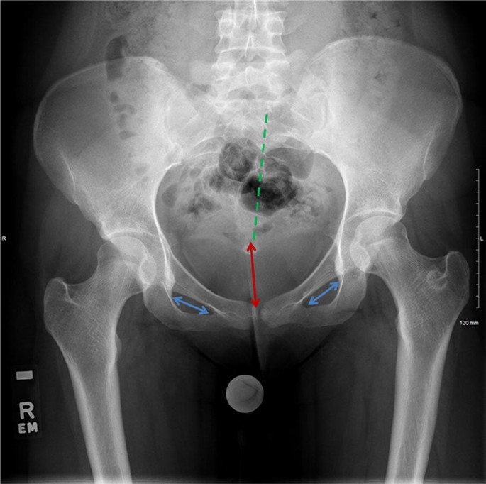 Assessment of the young adult hip joint using plain radiographs |  SpringerLink