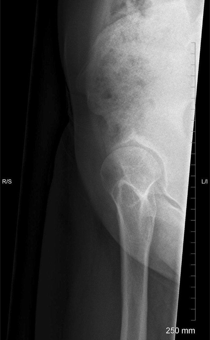 Assessment of the young adult hip joint using plain radiographs |  SpringerLink