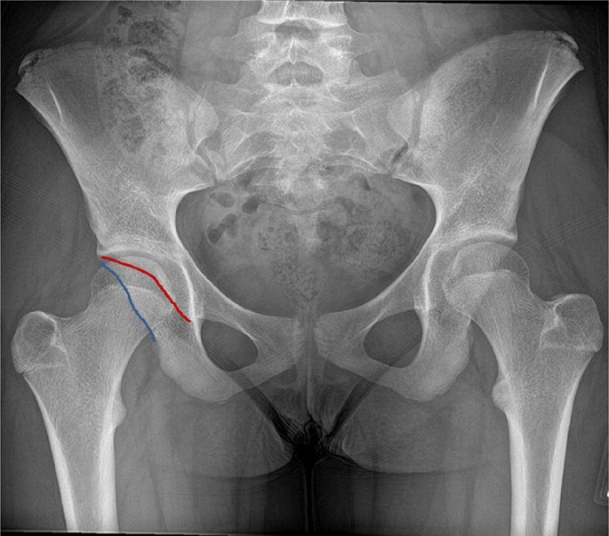 Assessment of the young adult hip joint using plain radiographs |  SpringerLink