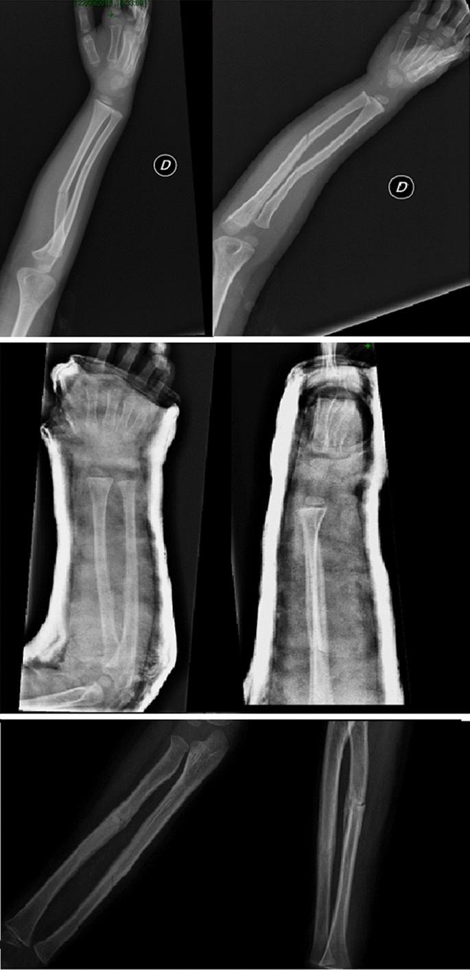 Featured image of post Bowing Fracture