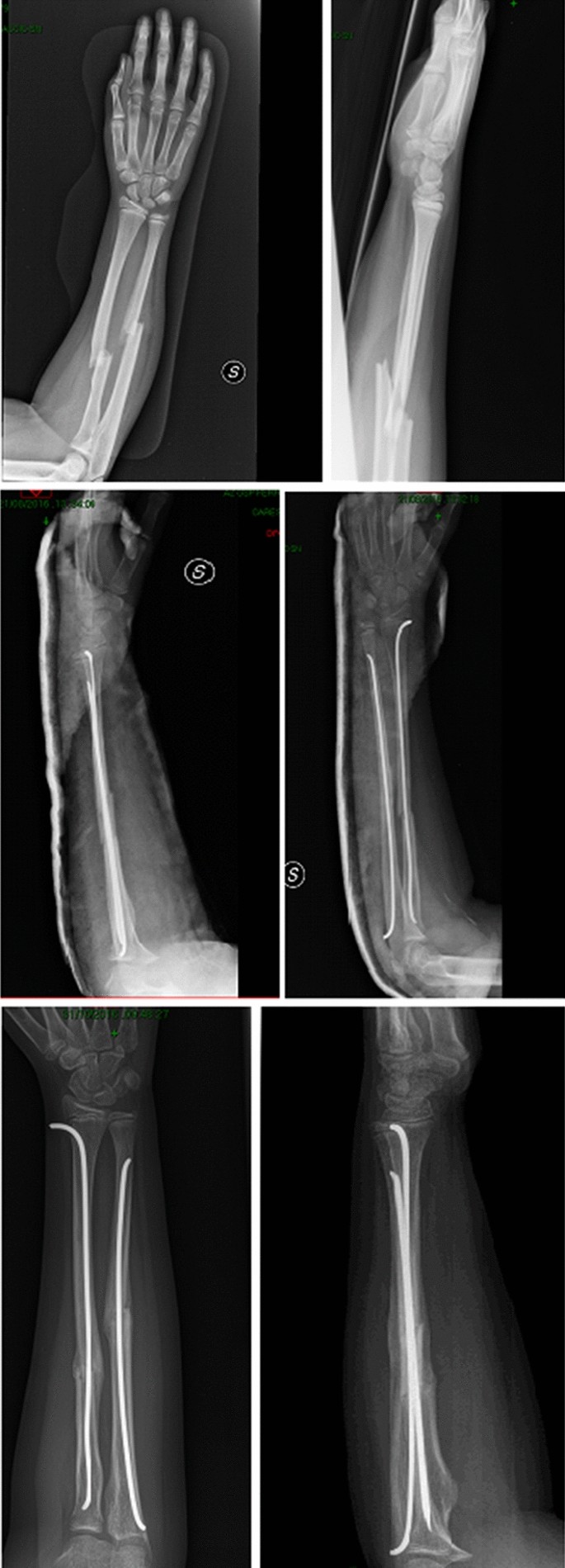 Implant removal associated complications after ESIN osteosynthesis in  pediatric fractures | European Journal of Trauma and Emergency Surgery