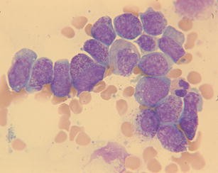 Acute Myeloid Leukemia With Promyelocytic Morphology Lacking Rara Rearrangement And With Double Minutes Myc Deletion And 2 Cell Lines With Amplification Of Myc Region Case Report And Literature Review Springerlink