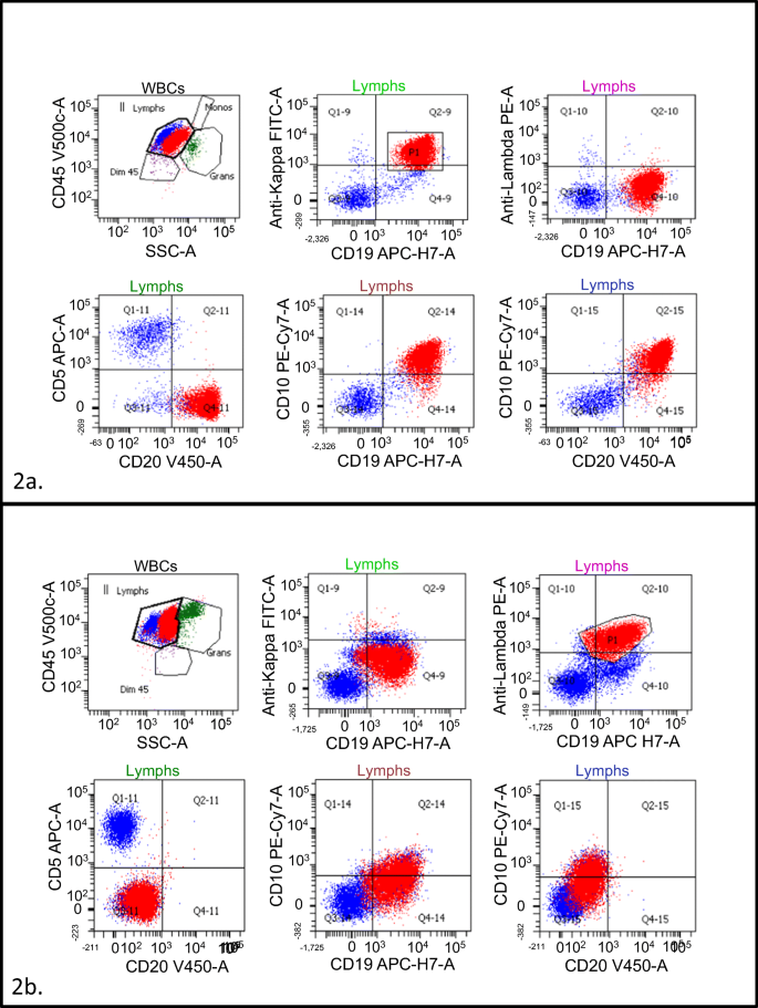 tag et billede mave skruenøgle Immunophenotypic and molecular analysis of a B cell lymphoma with  discordant light chain expression at different anatomic sites | SpringerLink