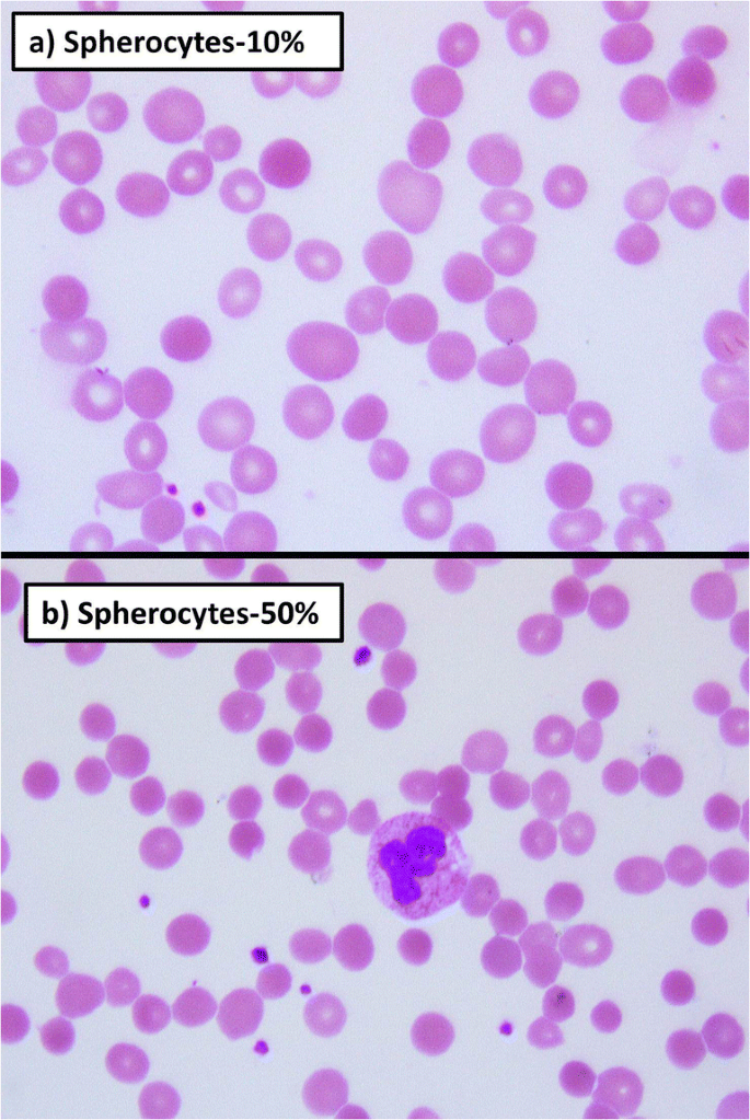 Utility of hyperchromic cell percentage, flags, and red cell cytograms  generated by Advia-120 hematology analyzer as a potential screening tool in  hereditary spherocytosis | SpringerLink
