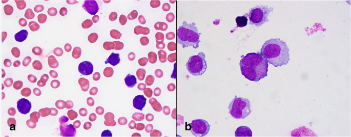Bronchoalveolar lavage fluid review in acute promyelocytic leukemia  differentiation syndrome | SpringerLink