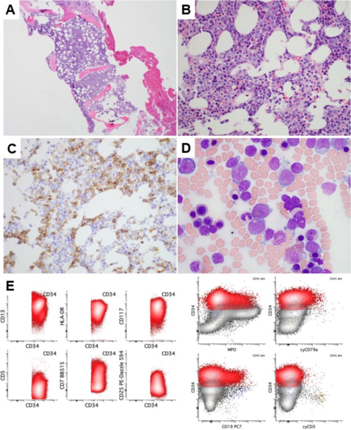 A novel IKZF1::FAM3C fusion associated with inversion of chromosome 7 ...
