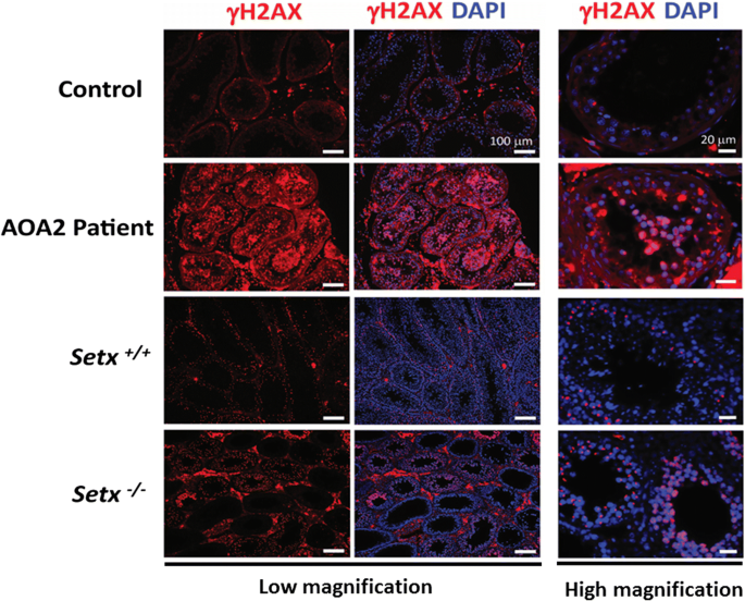 Disruption Of Spermatogenesis And Infertility In Ataxia With Oculomotor Apraxia Type 2 Aoa2 Springerlink