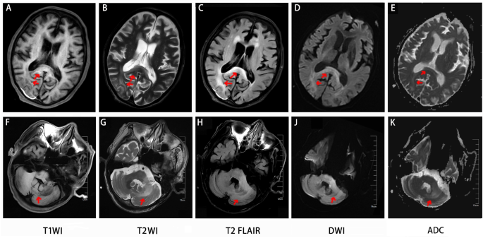 MRI Shrimp Sign and Parietooccipital Lesion in Progressive Multifocal ...