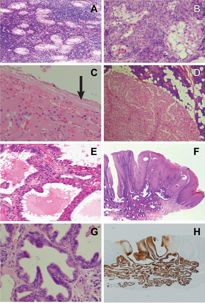 ductal papilloma salivary gland