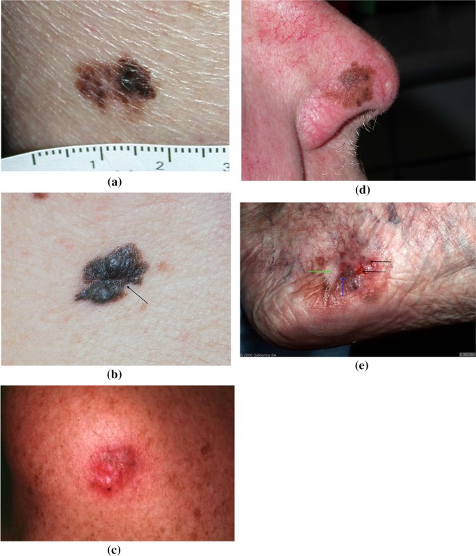 recognising skin cancer in primary care springerlink
