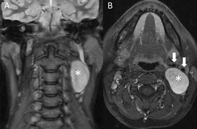 metastatic melanotic peripheral nerve sheath Benign Peripheral Non-cranial Nerve Sheath Tumors of the Neck | Advances in Therapy
