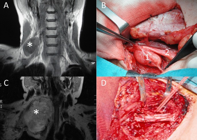 metastatic melanotic peripheral nerve sheath Benign Peripheral Non-cranial Nerve Sheath Tumors of the Neck | Advances in Therapy