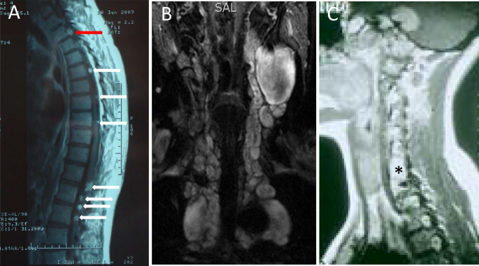 metastatic melanotic peripheral nerve Benign Peripheral Non-cranial Nerve Sheath Tumors of the Neck | Advances in Therapy