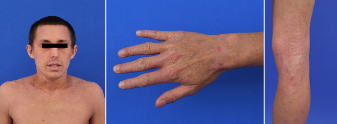 Dupilumab zur Behandlung der therapierefraktären atopischen Dermatitis |  SpringerLink