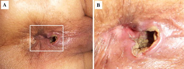 Granulocytic Sarcoma Presenting As A Thrombosed External Hemorrhoid In A Patient With Myelodysplastic Syndrome Overt Leukemia Springerlink