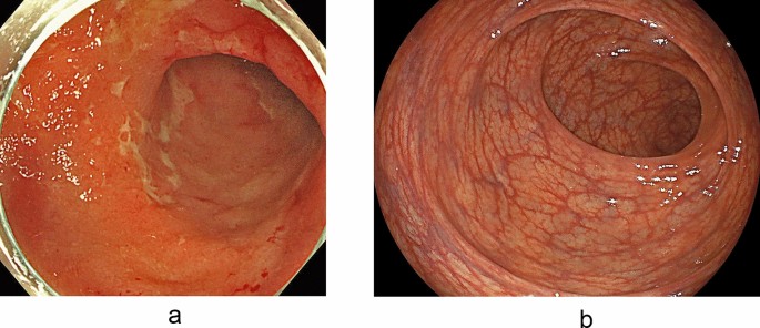 A case of ulcerative colitis in a patient undergoing surgery due to  exacerbation resulting in toxic megacolon after SARS-CoV-2 vaccination |  Clinical Journal of Gastroenterology | Springer Nature Link