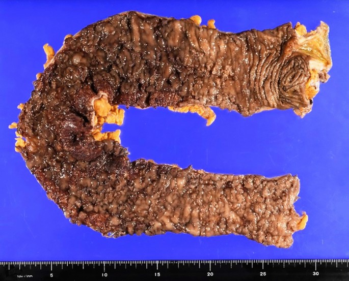A case of ulcerative colitis in a patient undergoing surgery due to  exacerbation resulting in toxic megacolon after SARS-CoV-2 vaccination |  Clinical Journal of Gastroenterology | Springer Nature Link